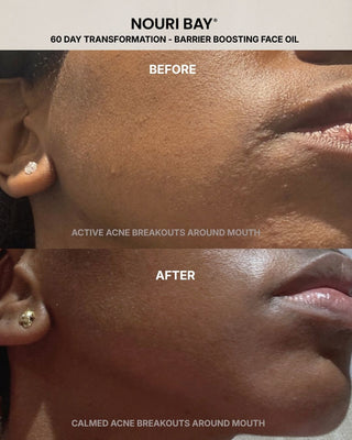 Before and after comparison of a person's cheek and mouth area showing skin improvement for Nouri Bay Barrier Boosting Face Oil, with text noting active acne breakouts around the mouth before and after use, sensitive skin.